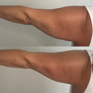 body contouring for arms in phoenix az